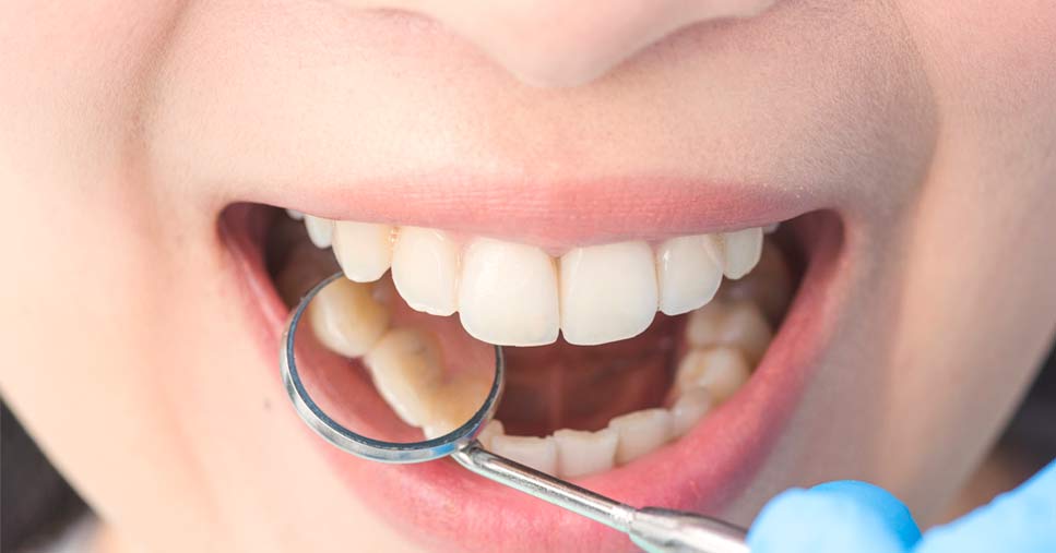 ¿Qué es una endodoncia?
