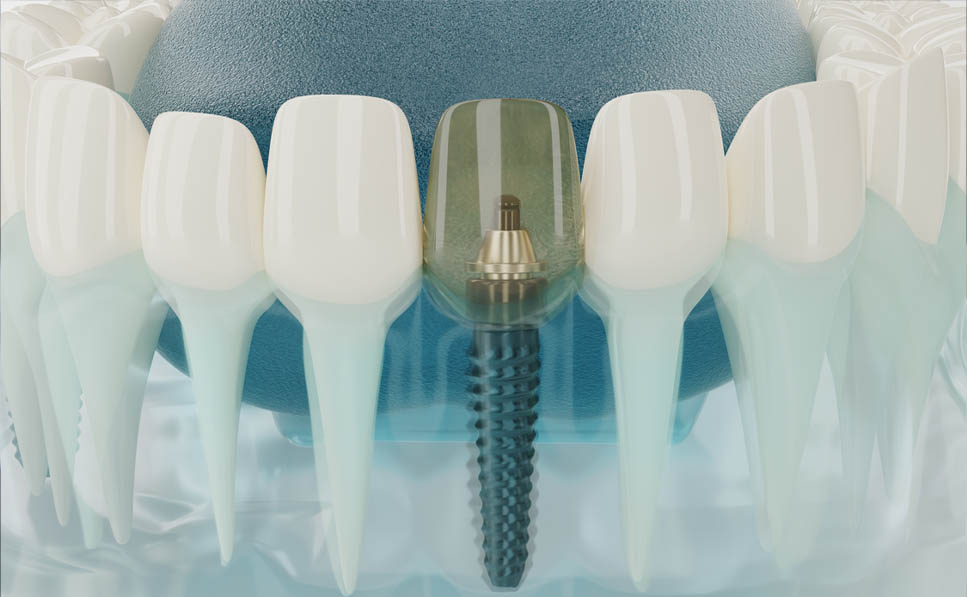 gracias a la osteointegración es posible fijar los implantes dentales al hueso